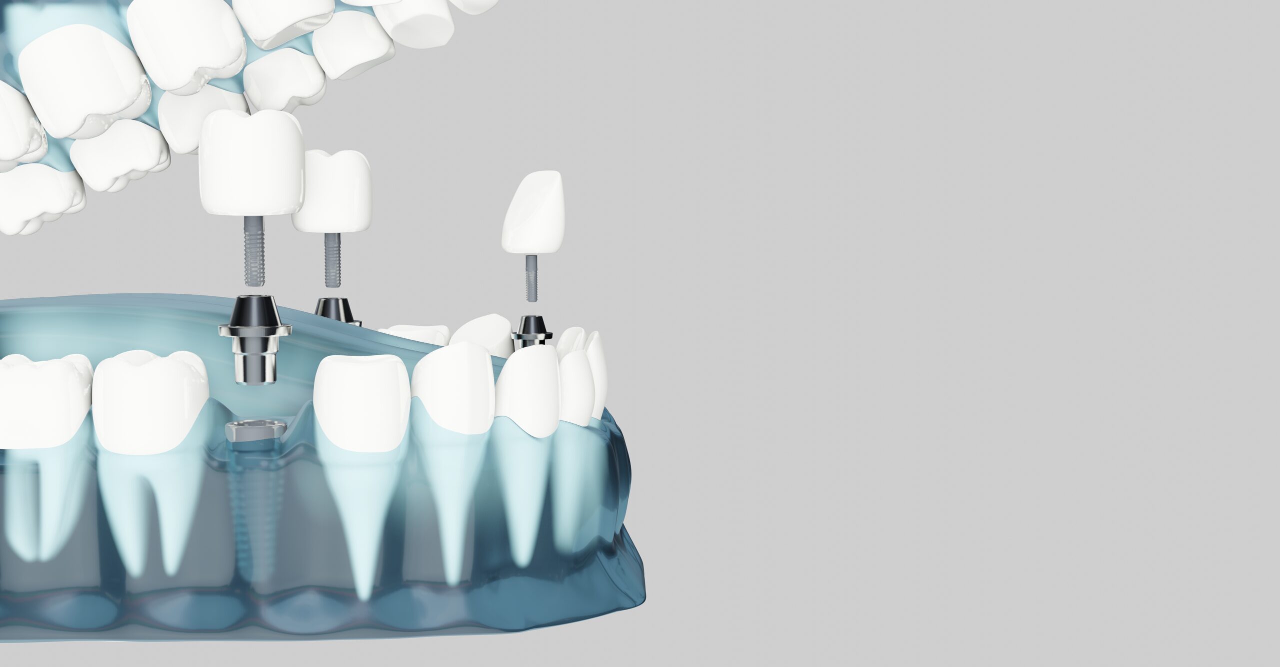 Lucrare dentară finalizată